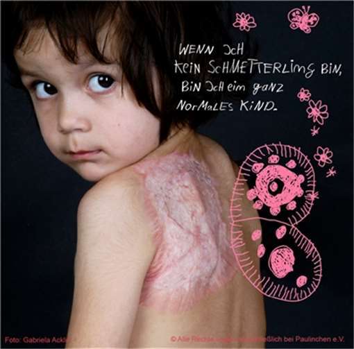 Das Motiv zum „Tag des brandverletzten Kindes“. Foto: Gabriela Acklin / © Alle Rechte liegen ausschließlich bei Paulinchen e.V.