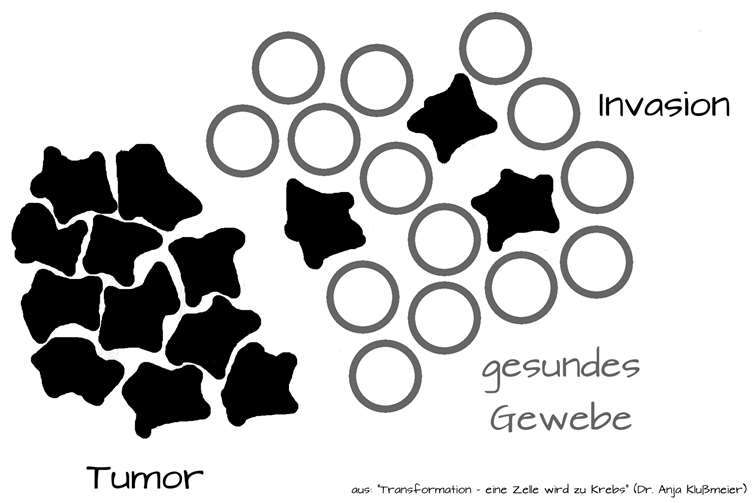 Die mutierten Krebszellen (schwarz) durchdringen das gesunde Gewebe (weiß).aus „Transformation – eine Zelle wird zu Krebs“, Dr. Anja Klußmeier