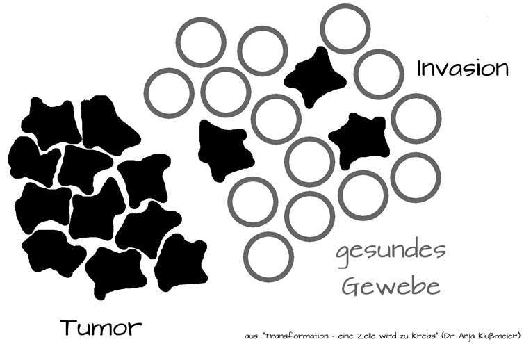 Die mutierten Krebszellen (schwarz) durchdringen das gesunde Gewebe (weiß).aus „Transformation – eine Zelle wird zu Krebs“, Dr. Anja Klußmeier